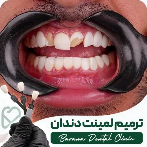لمینت دندان بعد از افتادن لمینت دندان چه کنیم؟