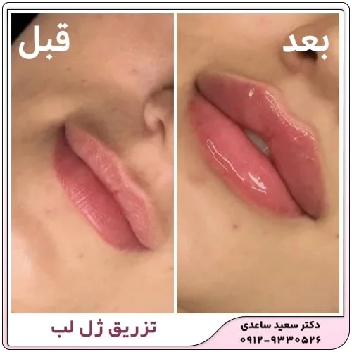 هزینه تزریق ژل لب در سال ۱۴۰۳